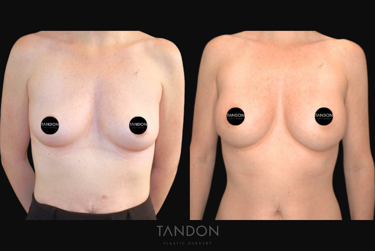 Breast Augmentation  Before & After Gallery - Patient 320290 - Image 1