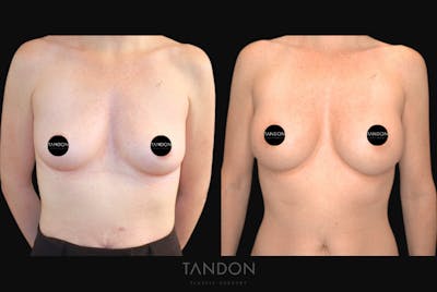 Breast Augmentation Before & After Gallery - Patient 320290 - Image 1