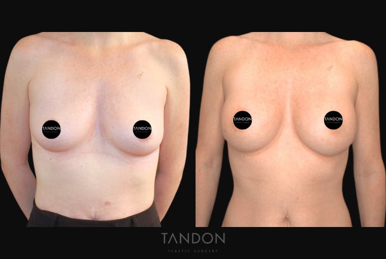 Breast Augmentation Before & After Gallery - Patient 320290 - Image 1