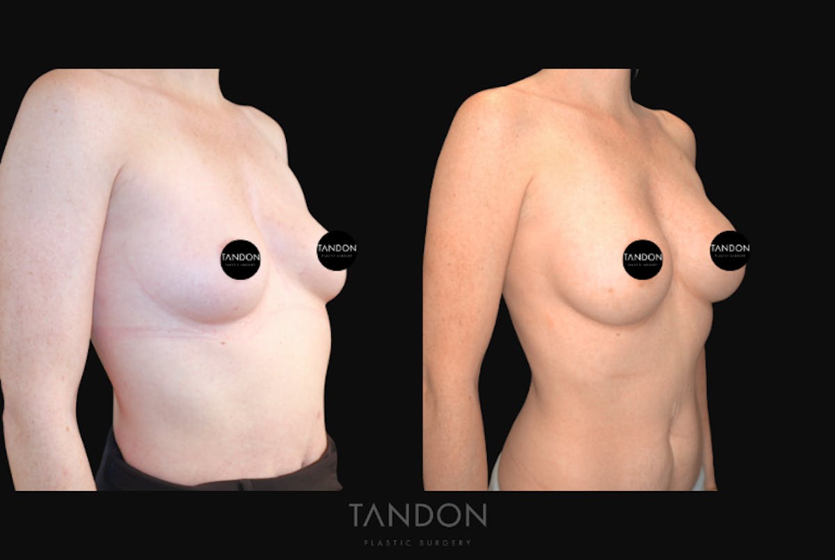 Breast Augmentation  Before & After Gallery - Patient 320290 - Image 2