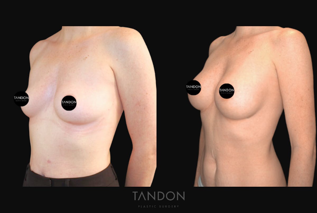 Breast Augmentation  Before & After Gallery - Patient 320290 - Image 5