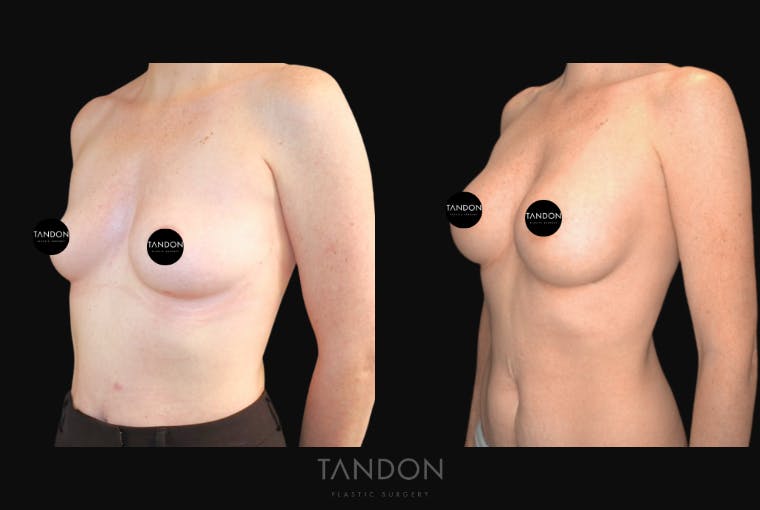 Breast Augmentation Before & After Gallery - Patient 320290 - Image 5
