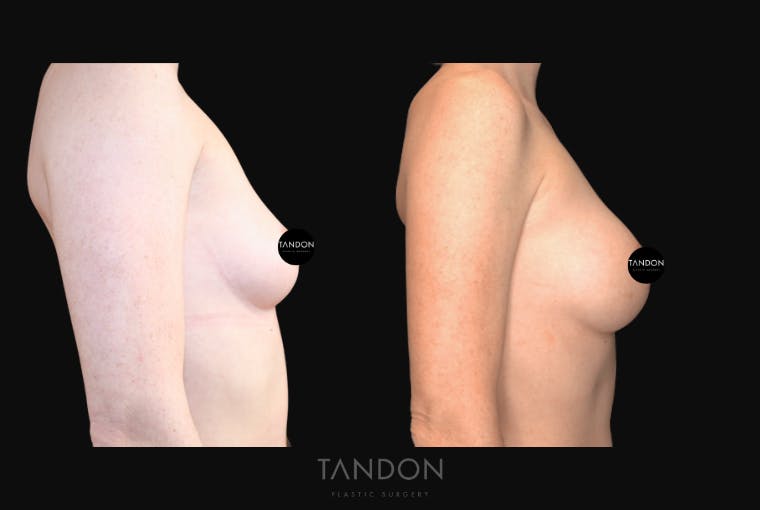 Breast Augmentation Before & After Gallery - Patient 320290 - Image 3