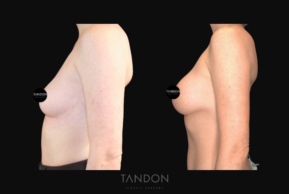 Breast Augmentation  Before & After Gallery - Patient 320290 - Image 4