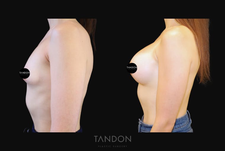 Breast Augmentation Before & After Gallery - Patient 296938 - Image 4