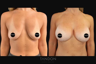 Breast Augmentation Before & After Gallery - Patient 456224 - Image 1