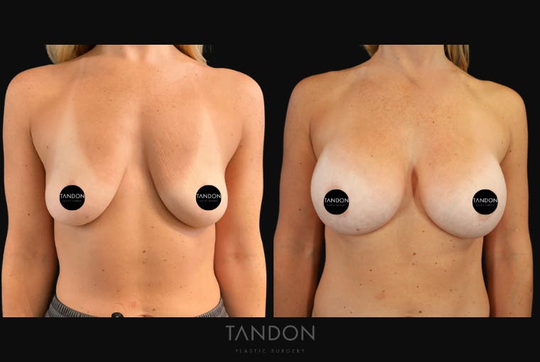 Breast Augmentation Before & After Gallery - Patient 456224 - Image 1