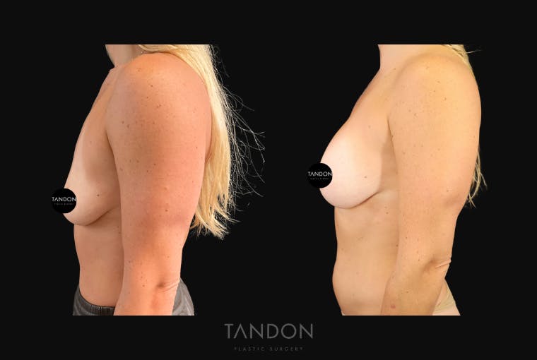 Breast Augmentation Before & After Gallery - Patient 456224 - Image 3