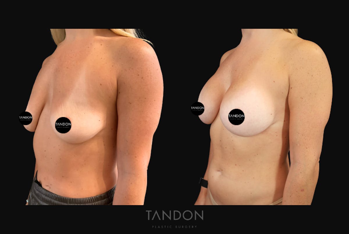Breast Augmentation  Before & After Gallery - Patient 456224 - Image 2