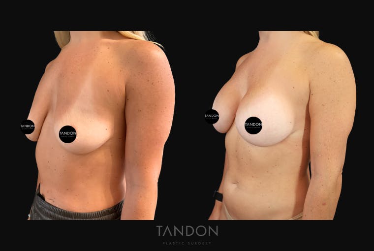 Breast Augmentation Before & After Gallery - Patient 456224 - Image 2