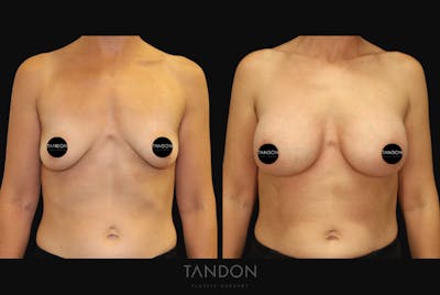 Breast Augmentation Before & After Gallery - Patient 336148 - Image 1
