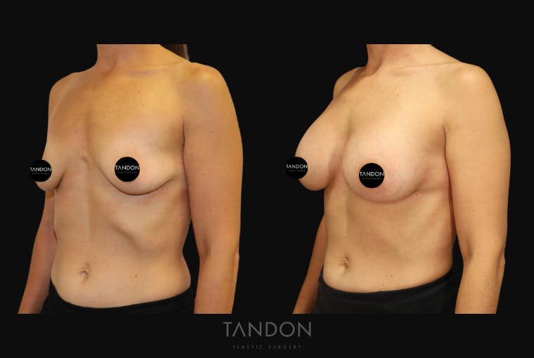 Breast Augmentation Before & After Gallery - Patient 336148 - Image 3