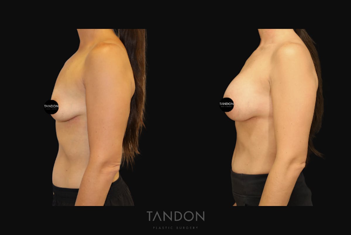 Breast Augmentation  Before & After Gallery - Patient 336148 - Image 4
