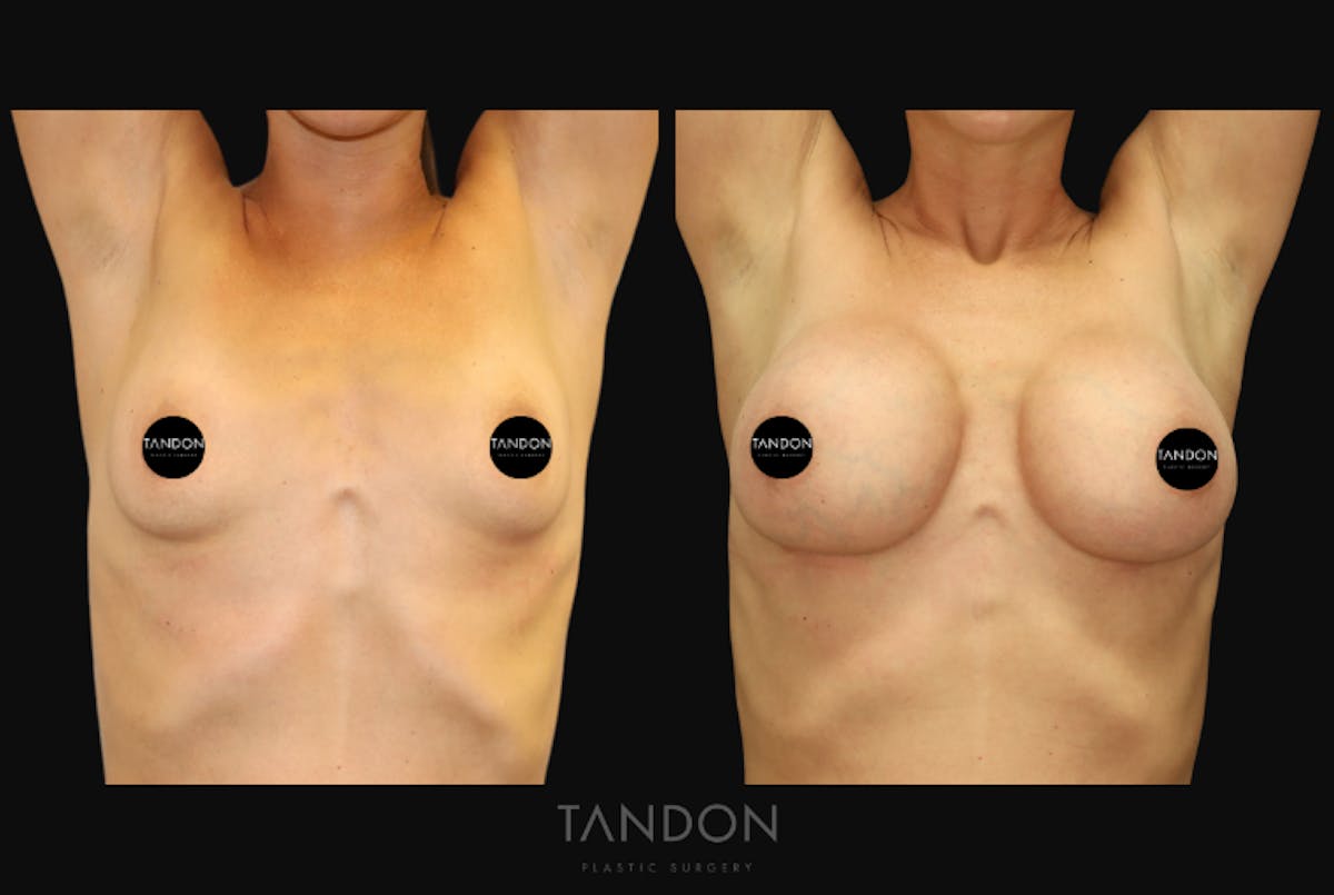 Breast Augmentation  Before & After Gallery - Patient 336148 - Image 2