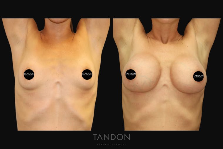 Breast Augmentation Before & After Gallery - Patient 336148 - Image 2