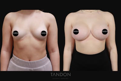 Breast Augmentation Before & After Gallery - Patient 192303 - Image 1