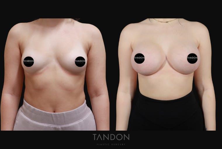 Breast Augmentation Before & After Gallery - Patient 192303 - Image 1