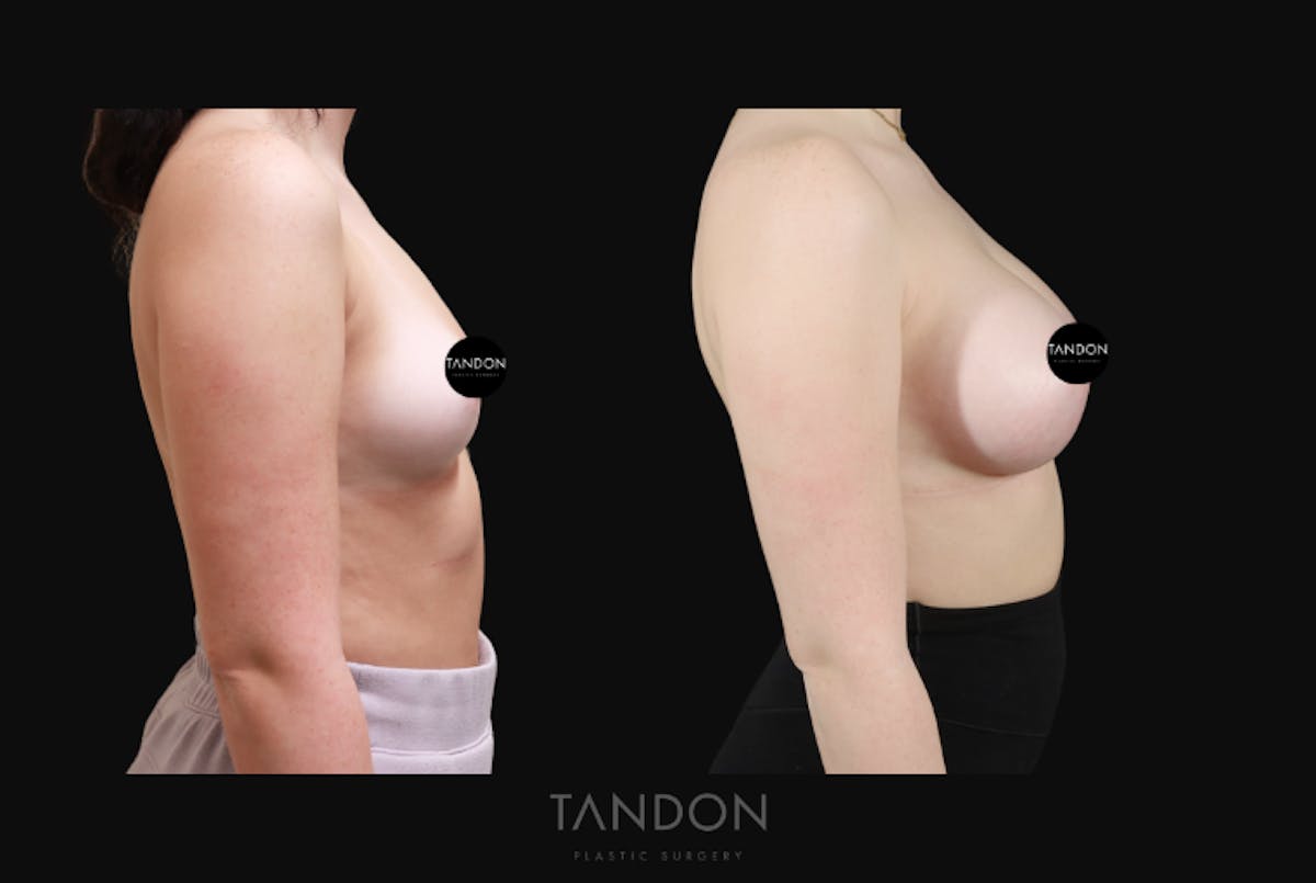 Breast Augmentation Before & After Gallery - Patient 192303 - Image 3