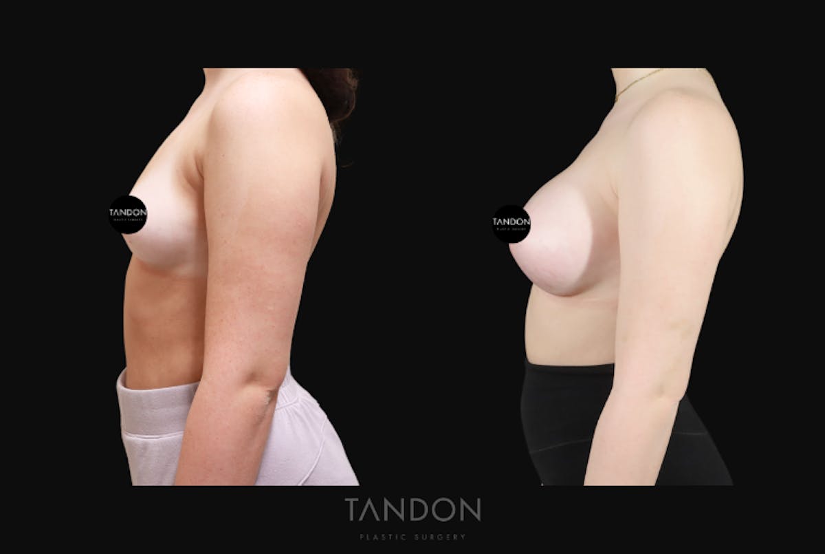Breast Augmentation Before & After Gallery - Patient 192303 - Image 4