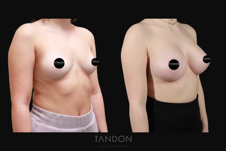Breast Augmentation Before & After Gallery - Patient 192303 - Image 2
