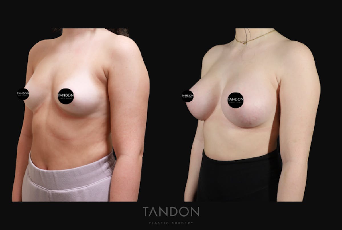 Breast Augmentation Before & After Gallery - Patient 192303 - Image 5