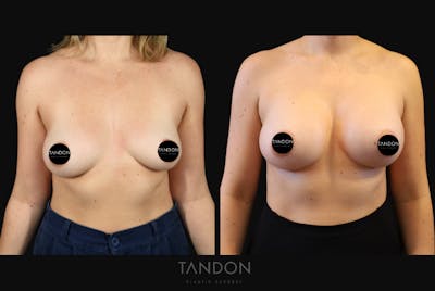 Breast Augmentation Before & After Gallery - Patient 114485 - Image 1