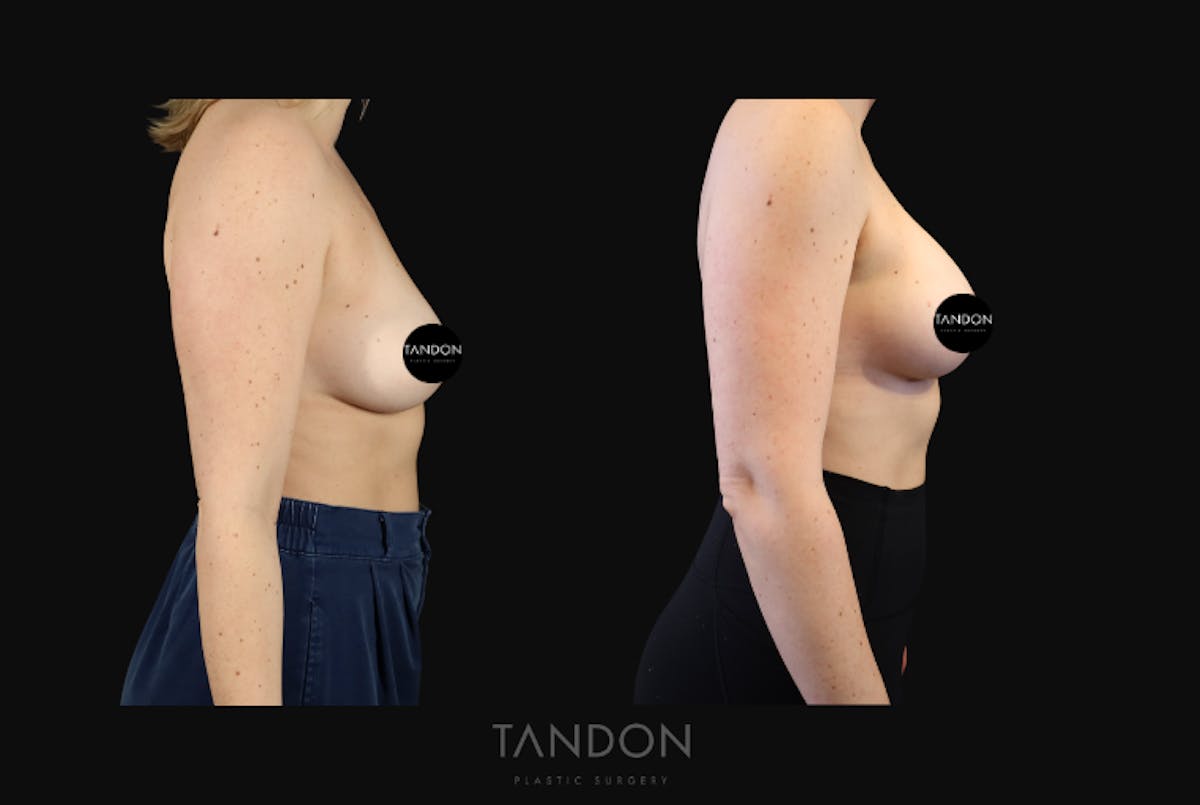 Breast Augmentation Before & After Gallery - Patient 114485 - Image 3