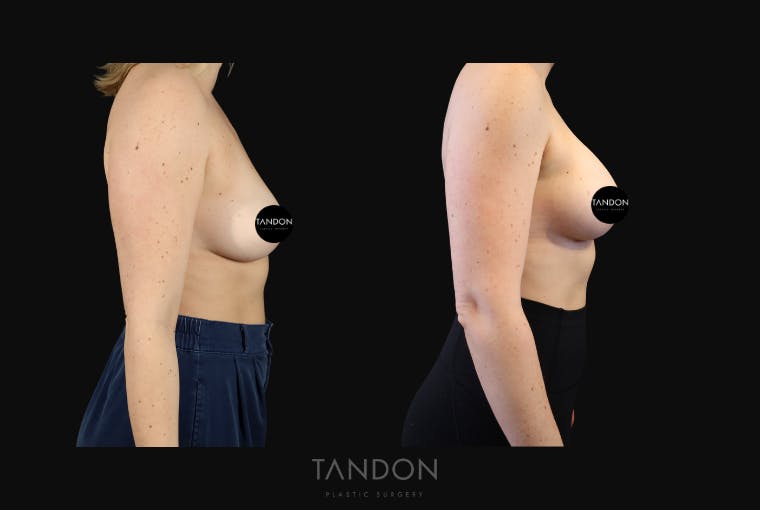 Breast Augmentation Before & After Gallery - Patient 114485 - Image 3