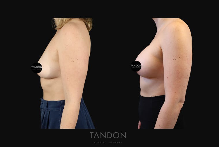 Breast Augmentation Before & After Gallery - Patient 114485 - Image 4