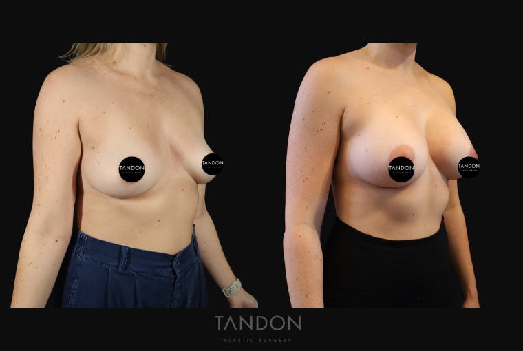 Breast Augmentation Before & After Gallery - Patient 114485 - Image 2