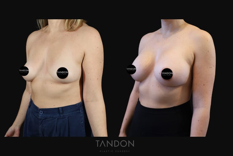 Breast Augmentation Before & After Gallery - Patient 114485 - Image 5