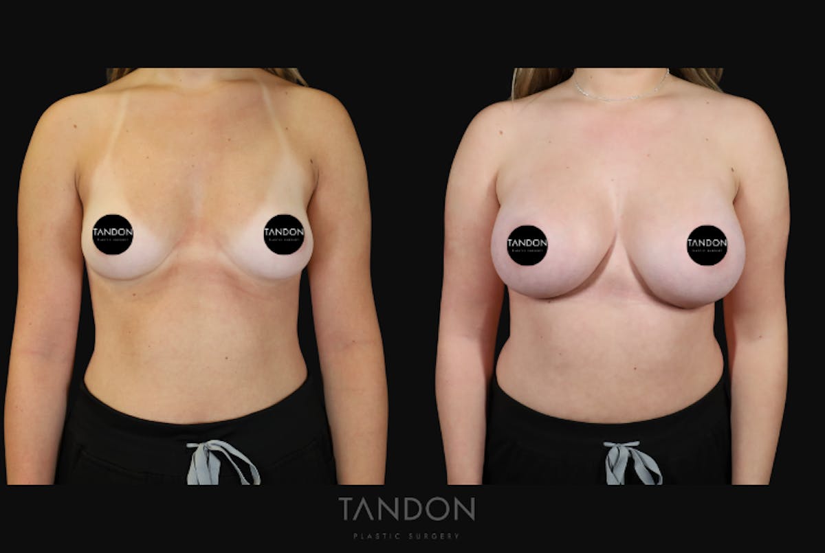 Breast Augmentation Before & After Gallery - Patient 529204 - Image 1