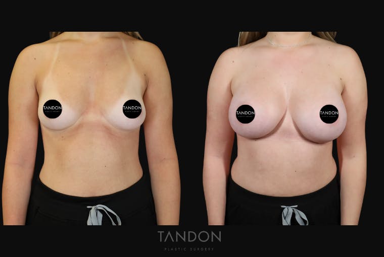 Breast Augmentation Before & After Gallery - Patient 529204 - Image 1