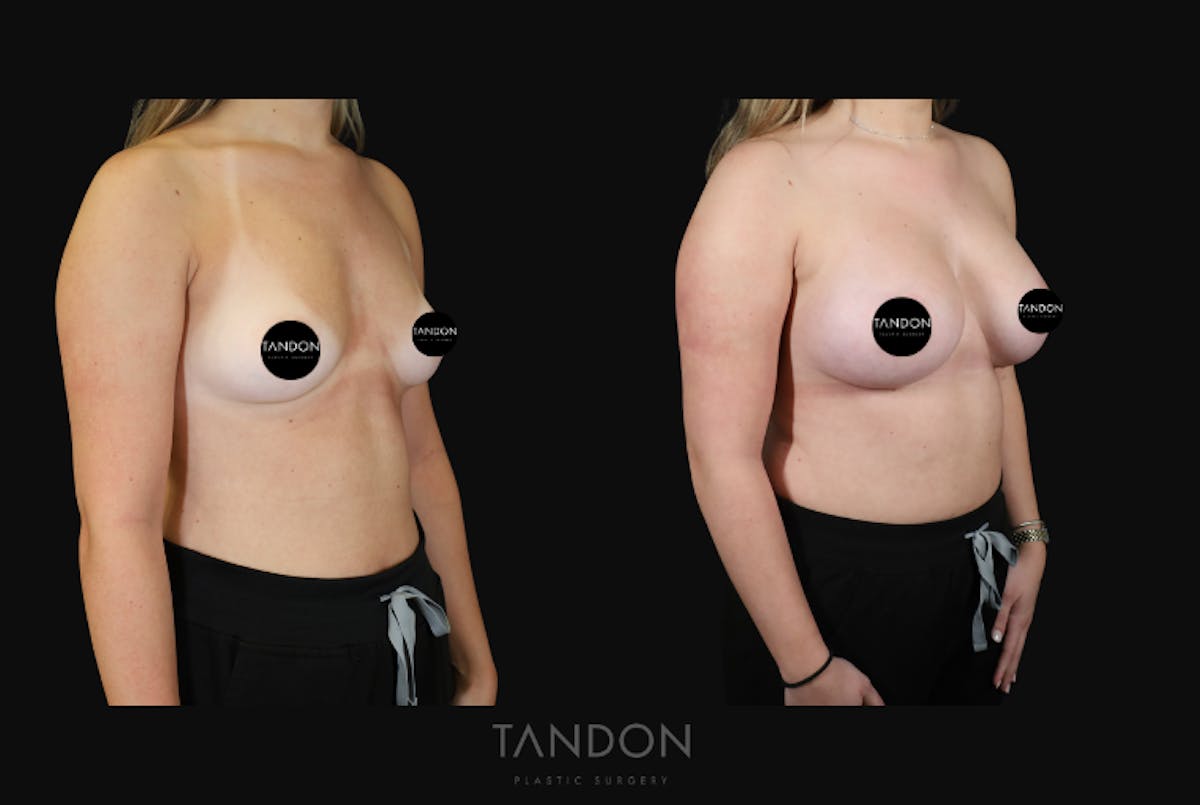 Breast Augmentation Before & After Gallery - Patient 529204 - Image 2