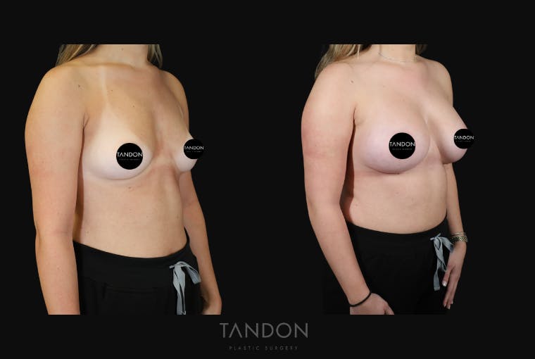 Breast Augmentation Before & After Gallery - Patient 529204 - Image 2