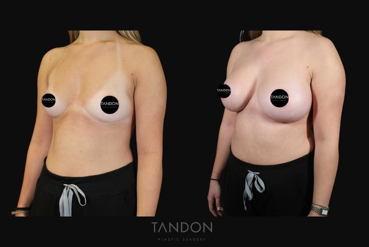 Breast Augmentation Before & After Gallery - Patient 529204 - Image 5