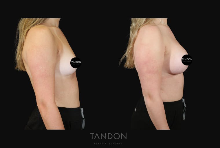 Breast Augmentation Before & After Gallery - Patient 529204 - Image 3