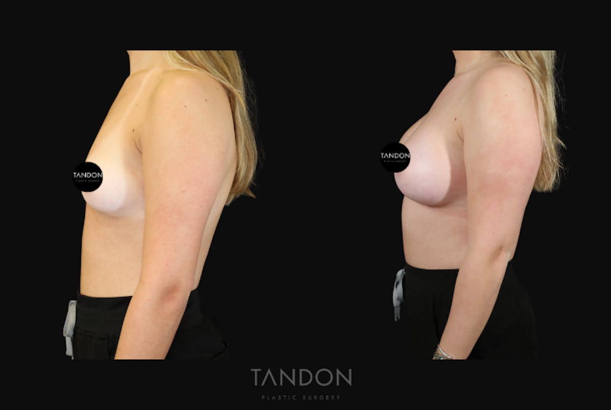 Breast Augmentation Before & After Gallery - Patient 529204 - Image 4