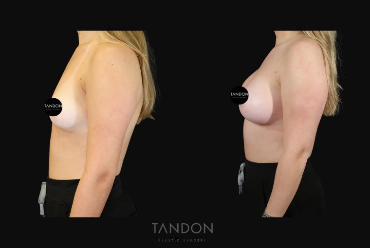 Breast Augmentation Before & After Gallery - Patient 529204 - Image 4