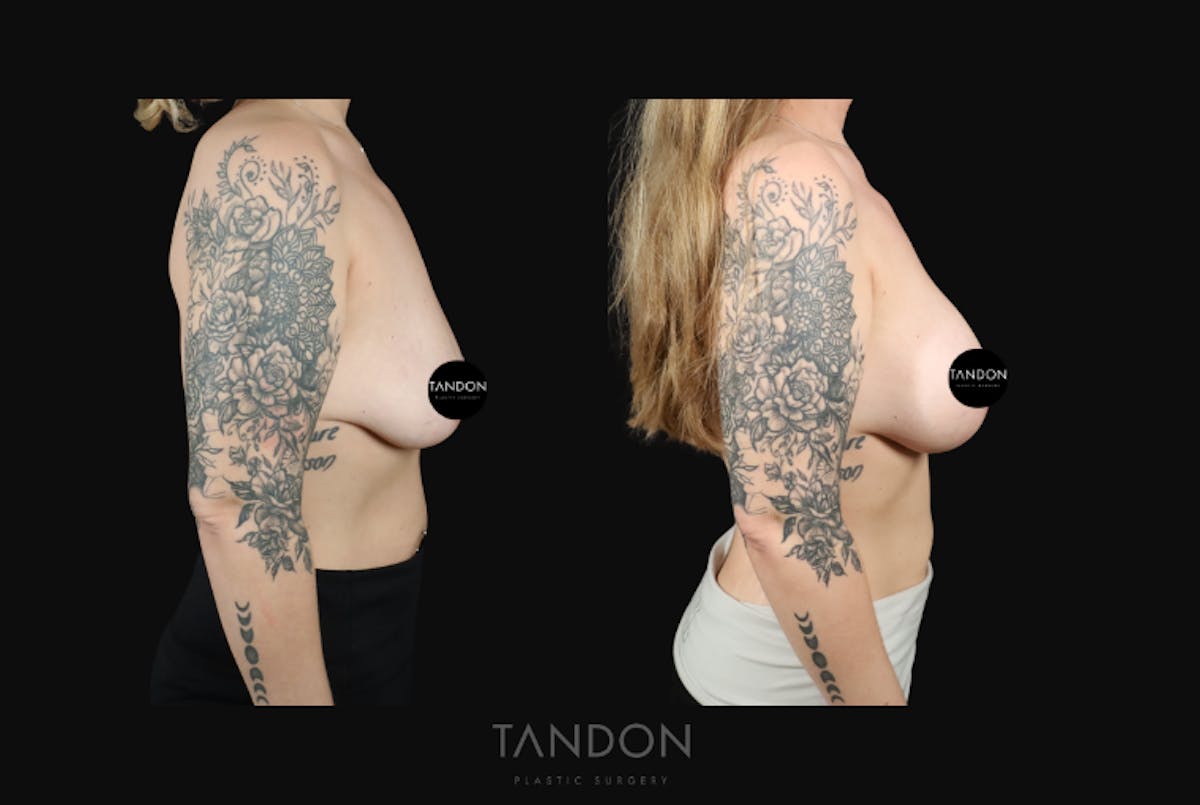 Breast Augmentation  Before & After Gallery - Patient 548332 - Image 3