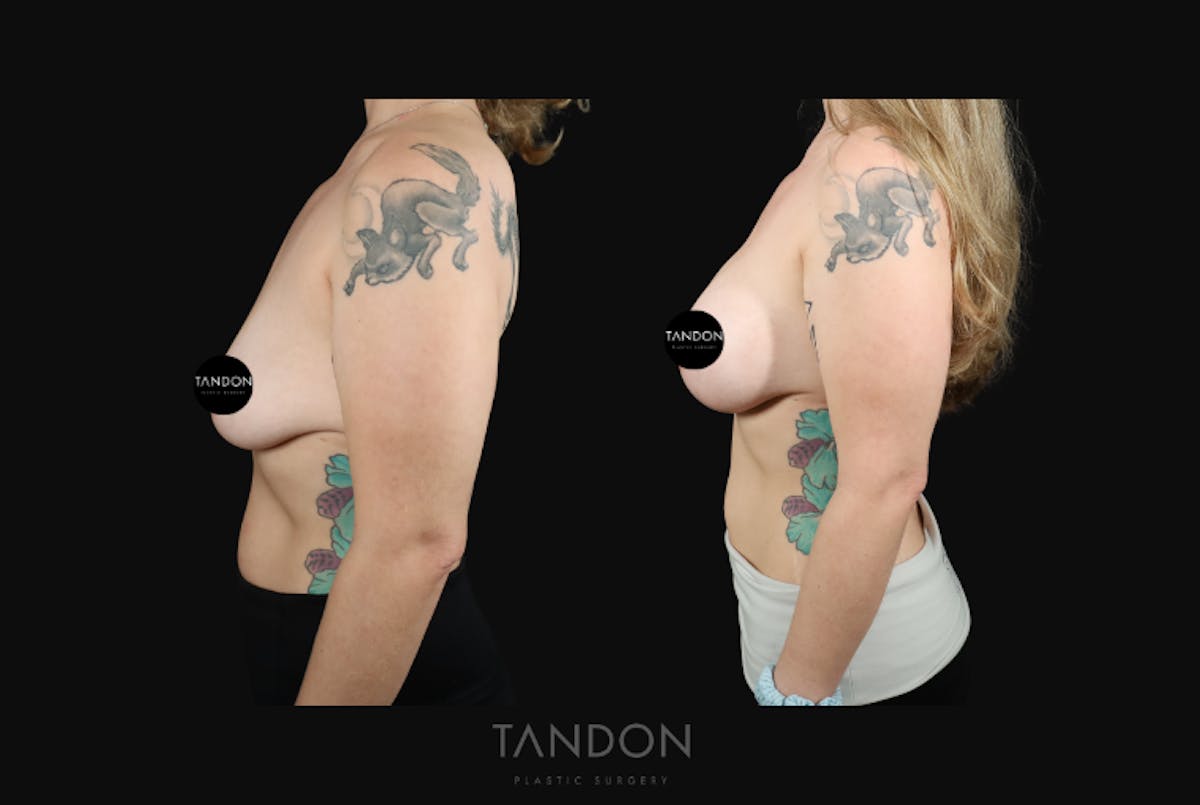 Breast Augmentation  Before & After Gallery - Patient 548332 - Image 4