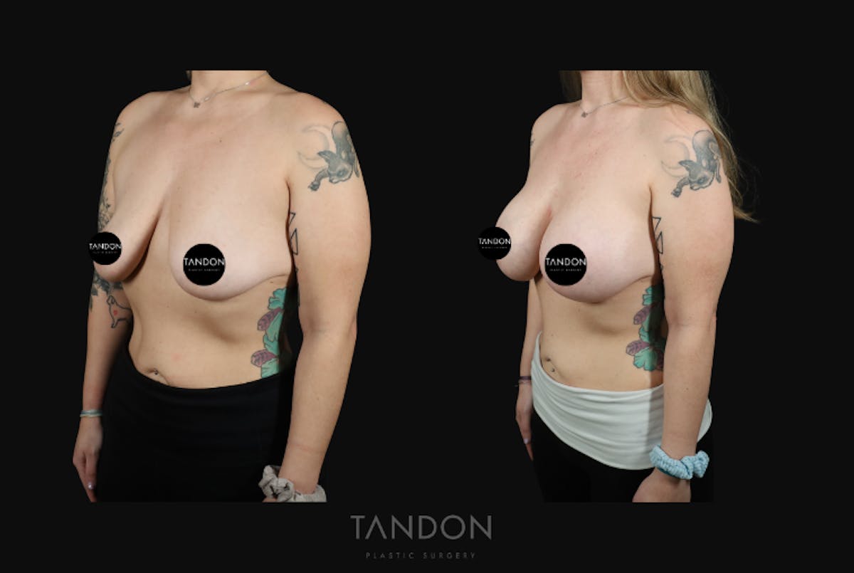 Breast Augmentation  Before & After Gallery - Patient 548332 - Image 5