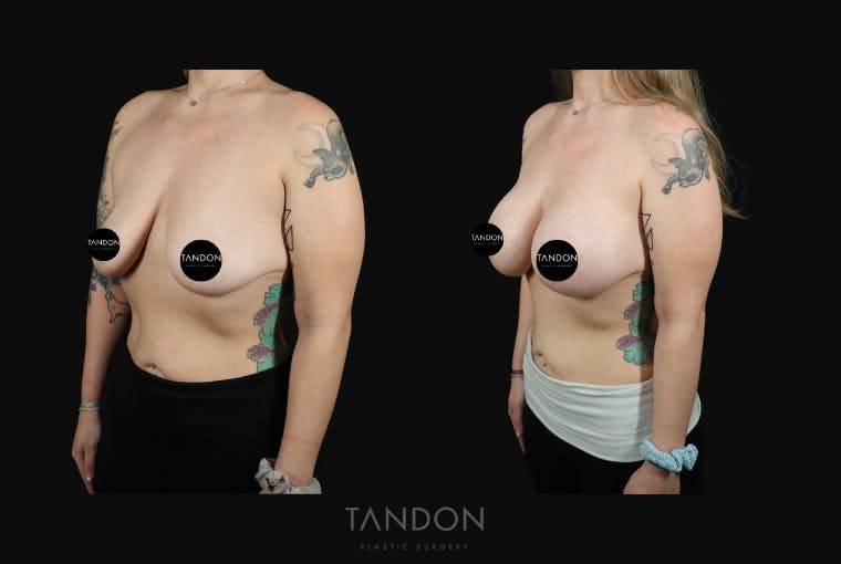 Breast Augmentation Before & After Gallery - Patient 548332 - Image 5