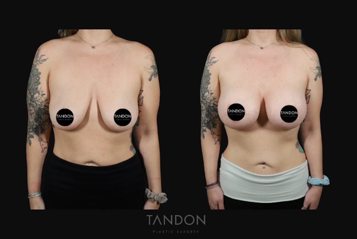 Breast Augmentation  Before & After Gallery - Patient 548332 - Image 1