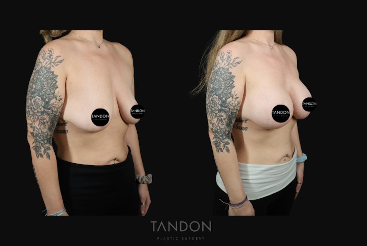 Breast Augmentation  Before & After Gallery - Patient 548332 - Image 2