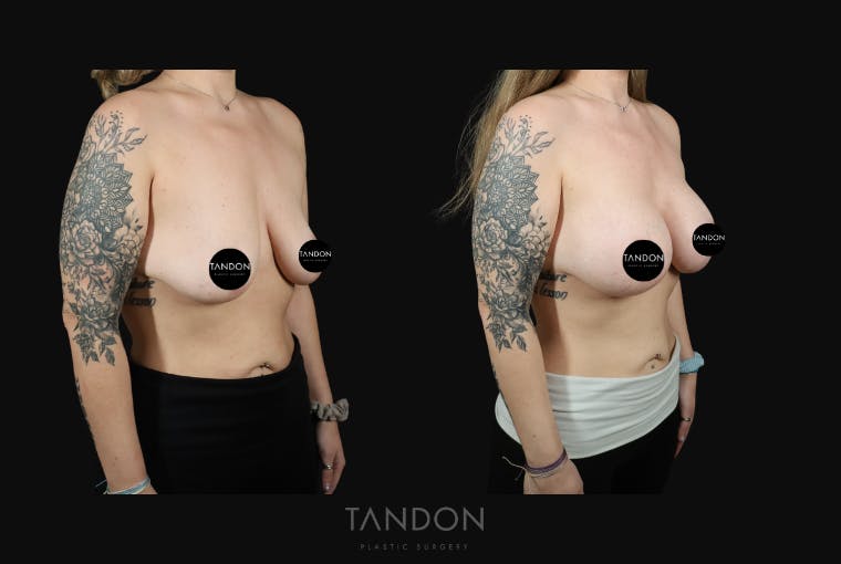 Breast Augmentation Before & After Gallery - Patient 548332 - Image 2