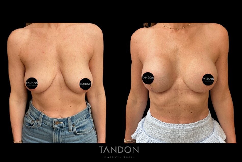 Breast Lift Before & After Gallery - Patient 326624 - Image 1