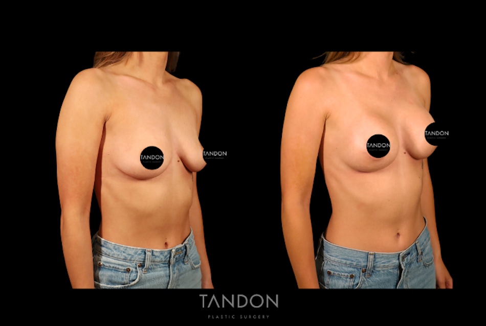 Preservé by Motiva Breast Augmentation Before & After Gallery - Patient 270312 - Image 2