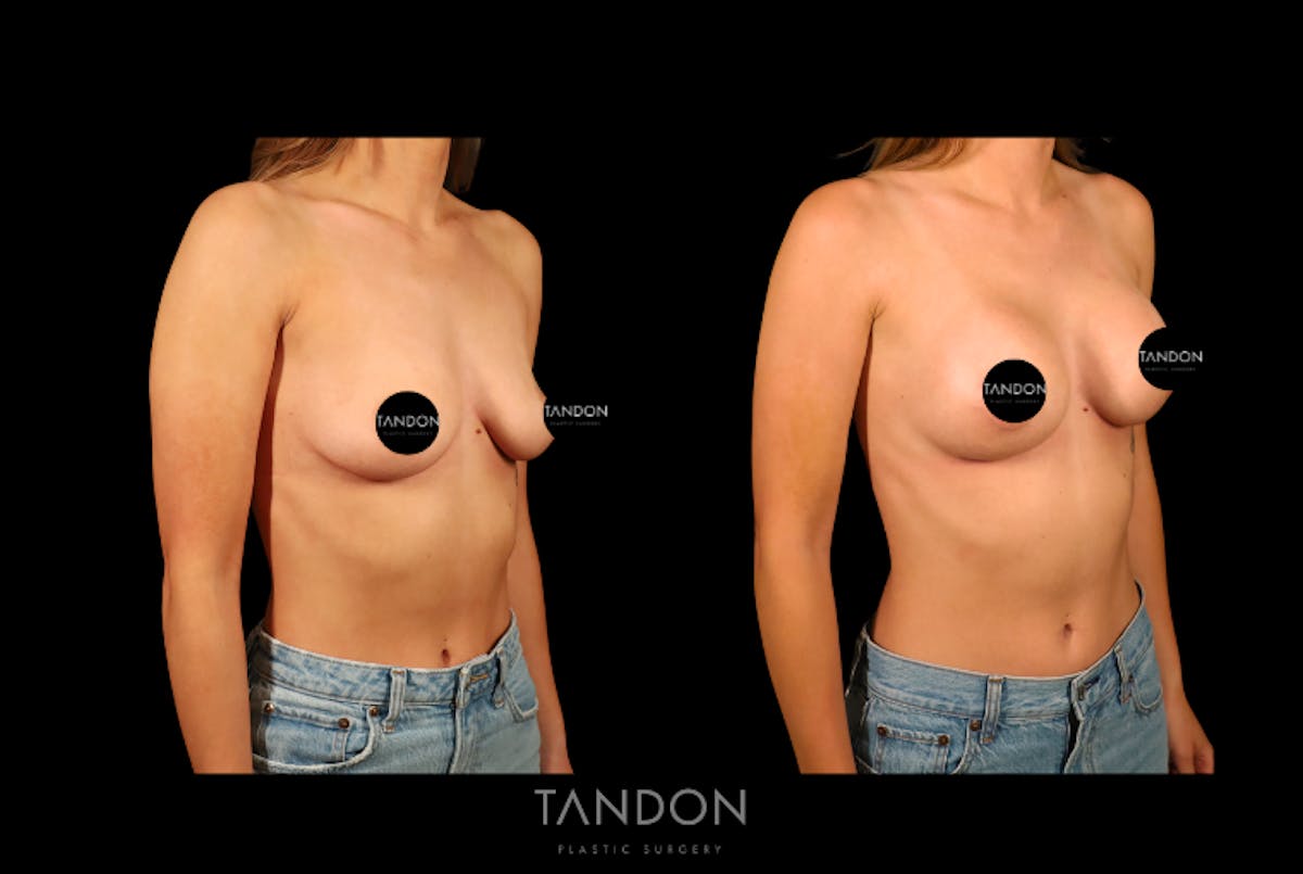 Breast Augmentation  Before & After Gallery - Patient 217753 - Image 2