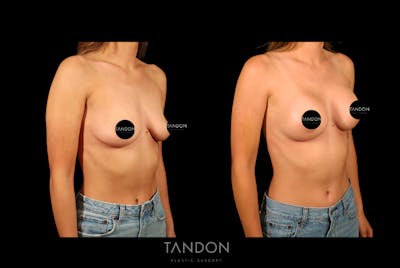 Preservé by Motiva Breast Augmentation Before & After Gallery - Patient 270312 - Image 2